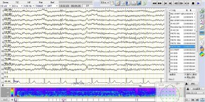 EEG